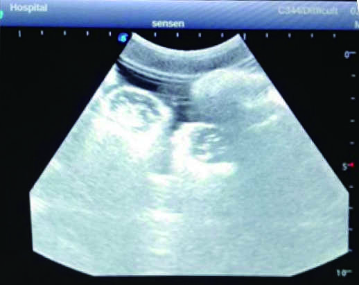 Femoral Arteriovenous Puncture & Abdominocentesis Ultrasound Training Model 